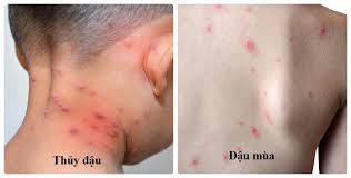 Đậu mùa - Hình ảnh minh họa